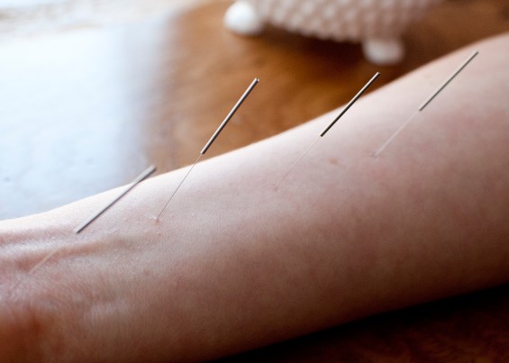 Acupuncture on medial arm